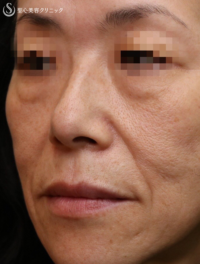 【50代女性・究極のアンチエイジング】プレミアムPRP皮膚再生療法（施術後3週間） Before 