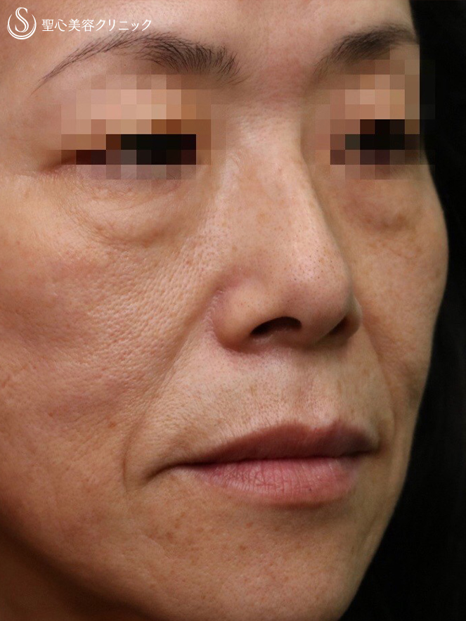 50代女性 究極のアンチエイジング プレミアムprp皮膚再生療法 施術後3週間 症例写真 美容整形 美容外科なら聖心美容クリニック 50代女性 究極のアンチエイジング プレミアムprp皮膚再生療法 施術後3週間 症例写真 美容整形 美容外科なら聖心美容クリニック