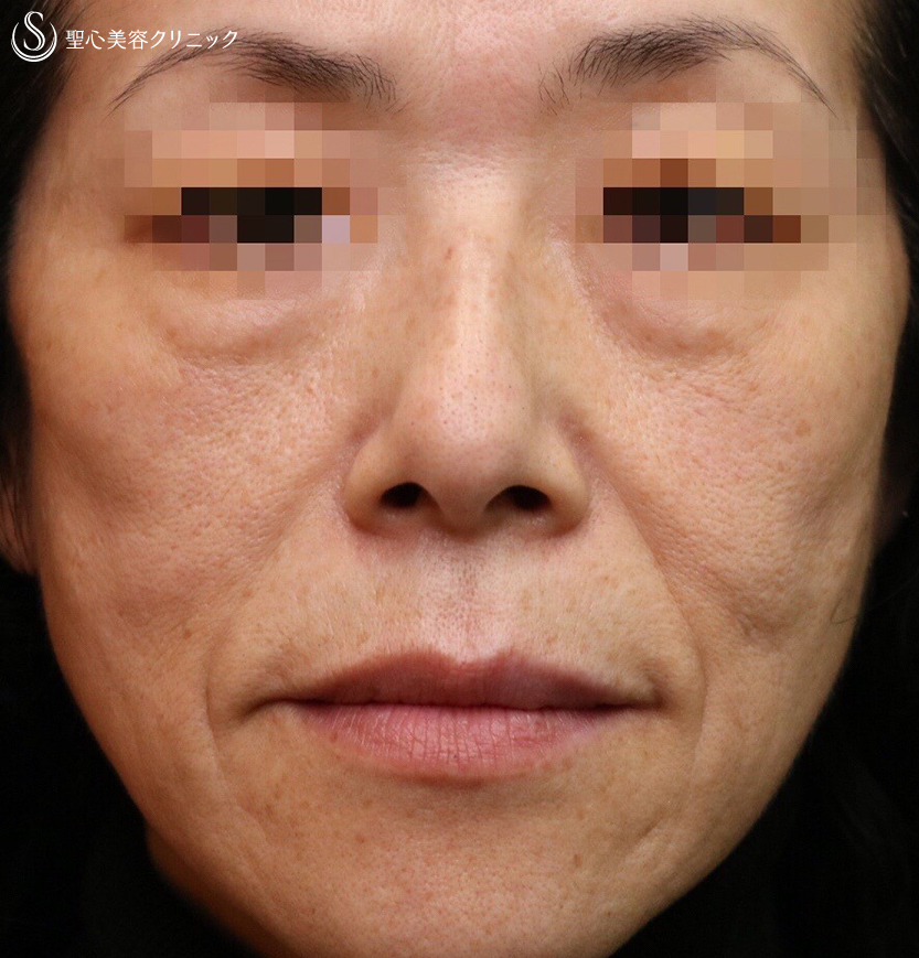 【50代女性・究極のアンチエイジング】プレミアムPRP皮膚再生療法（施術後3週間） Before 
