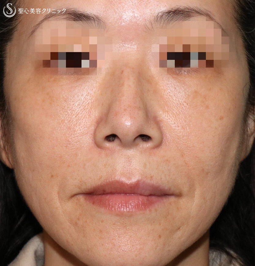 【50代女性・究極のアンチエイジング】プレミアムPRP皮膚再生療法（施術後3週間） After 