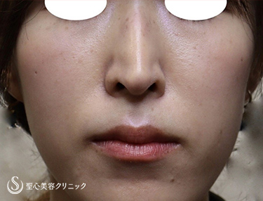 【30代女性・中顔面の凹みを改善、長く見えていたお顔がスッキリ】プレミアムPRP皮膚再生療法（施術後4ヶ月） After 