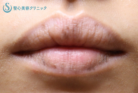 【20代女性・唇のシミ】ピコレーザー（1ヶ月後） Before 