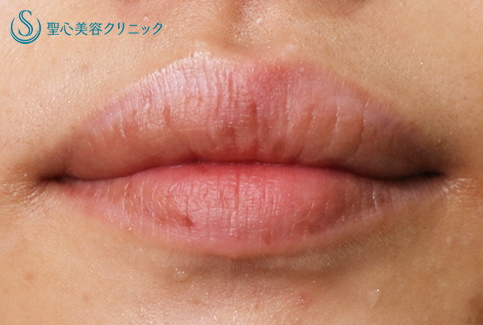 【20代女性・唇のシミ】ピコレーザー（1ヶ月後） After 