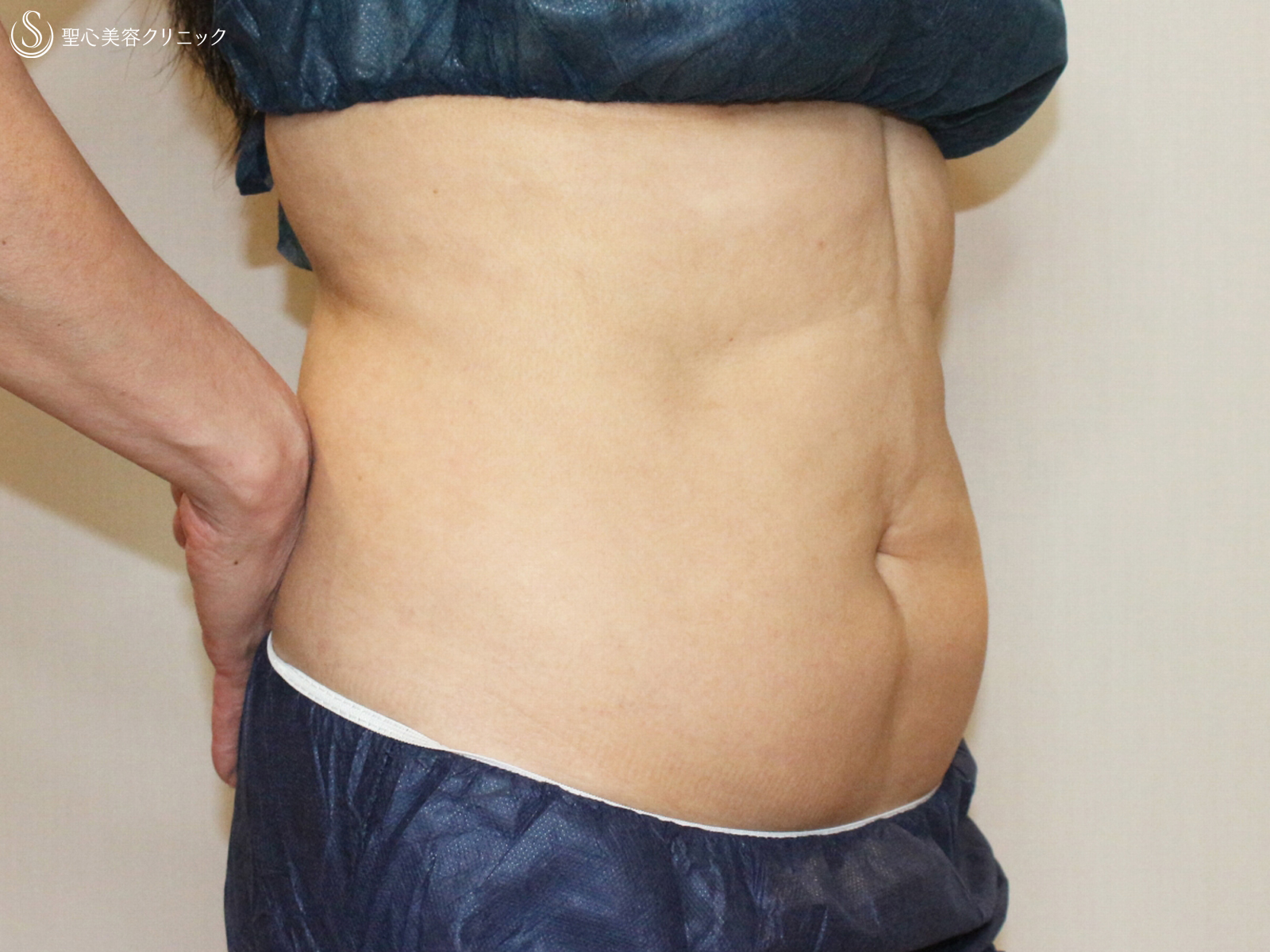 【50代女性・切らないお腹の痩身】リポセルモニター（3ヶ月後） Before 