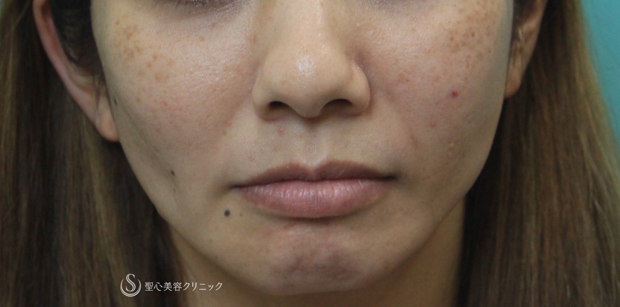 【30代女性・頬の脂肪吸引による痩せの修正】プレミアムPRP（3ヶ月後） Before 