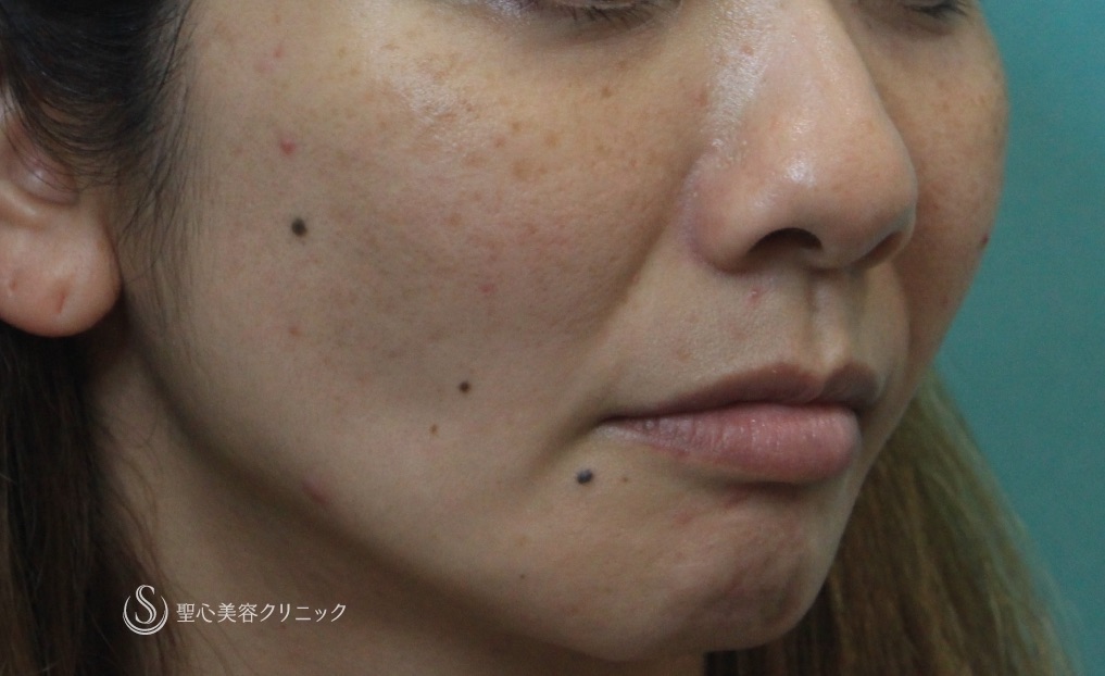 【30代女性・頬の脂肪吸引による痩せの修正】プレミアムPRP（3ヶ月後） Before 