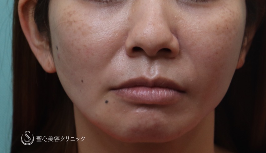 【30代女性・頬の脂肪吸引による痩せの修正】プレミアムPRP（3ヶ月後） After 