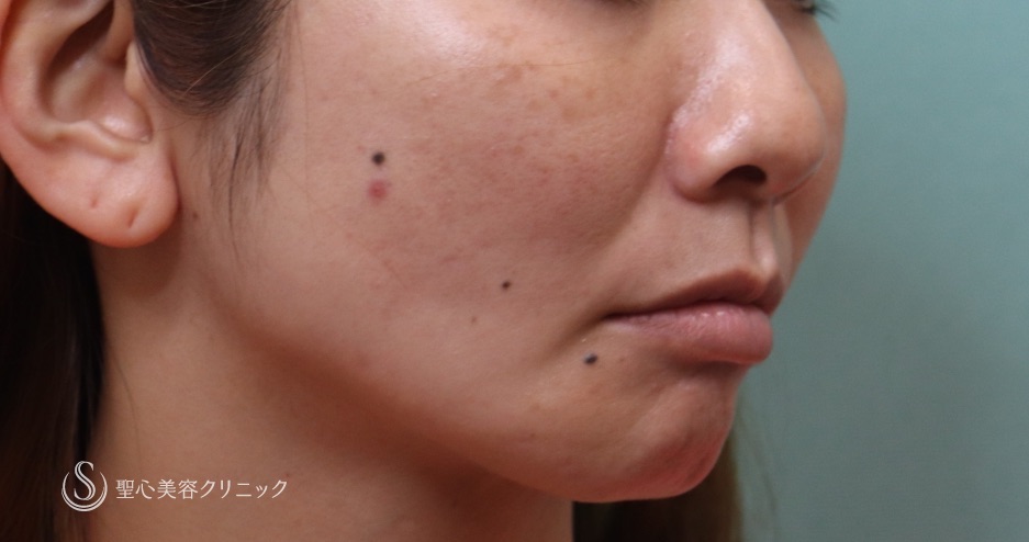 【30代女性・頬の脂肪吸引による痩せの修正】プレミアムPRP（3ヶ月後） After 