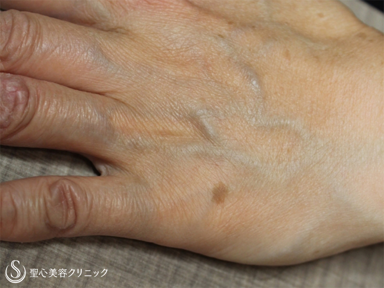 【50代女性・シミが気になる】右目尻のシミ、手の甲のシミのレーザー治療（8ヶ月後） Before 