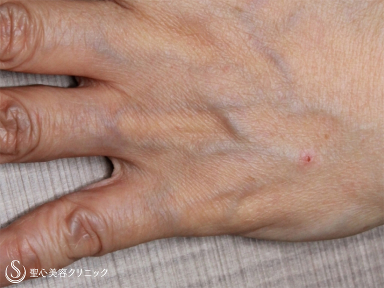 【50代女性・シミが気になる】右目尻のシミ、手の甲のシミのレーザー治療（8ヶ月後） After 