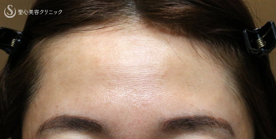【40代女性・丸いオデコを注入で】プレミアムPRP皮膚再生療法（7年後） Before 