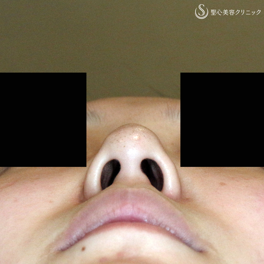 【20代女性・画期的なダンゴ鼻の治療】3D鼻尖用・PCLドーム（1年後） Before 