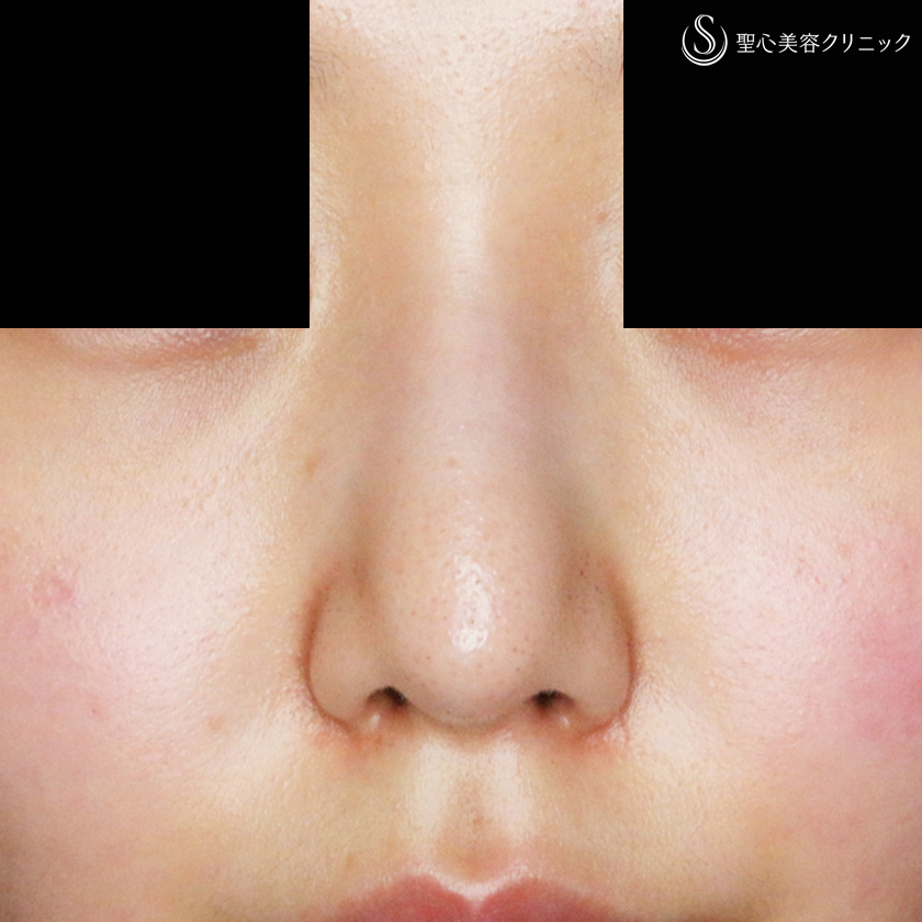 【20代女性・画期的なダンゴ鼻の治療】3D鼻尖用・PCLドーム（1年後） After 