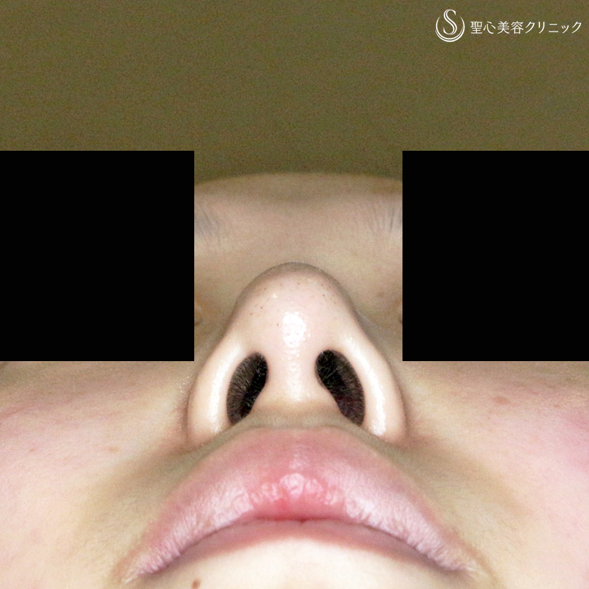 【20代女性・画期的なダンゴ鼻の治療】3D鼻尖用・PCLドーム（1年後） After 