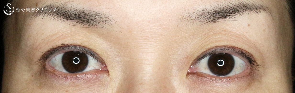 【40代女性・画期的な眼瞼下垂（埋没法）】切らない眼瞼下垂+α法（1年3ヶ月後） After 