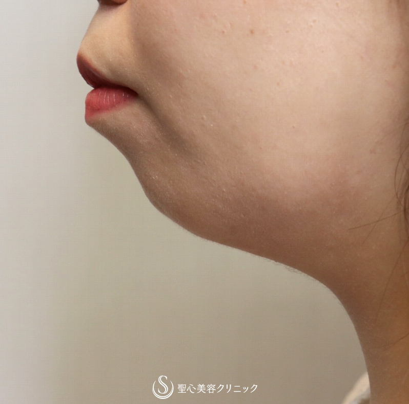 【20代女性・アゴだけでフェイスラインまで改善】あごヒアルロン酸注入（直後） Before 