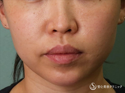 女性 顎がシャープに ヒアルロン酸注入 3ヶ月後 症例写真 美容整形 美容外科なら聖心美容クリニック