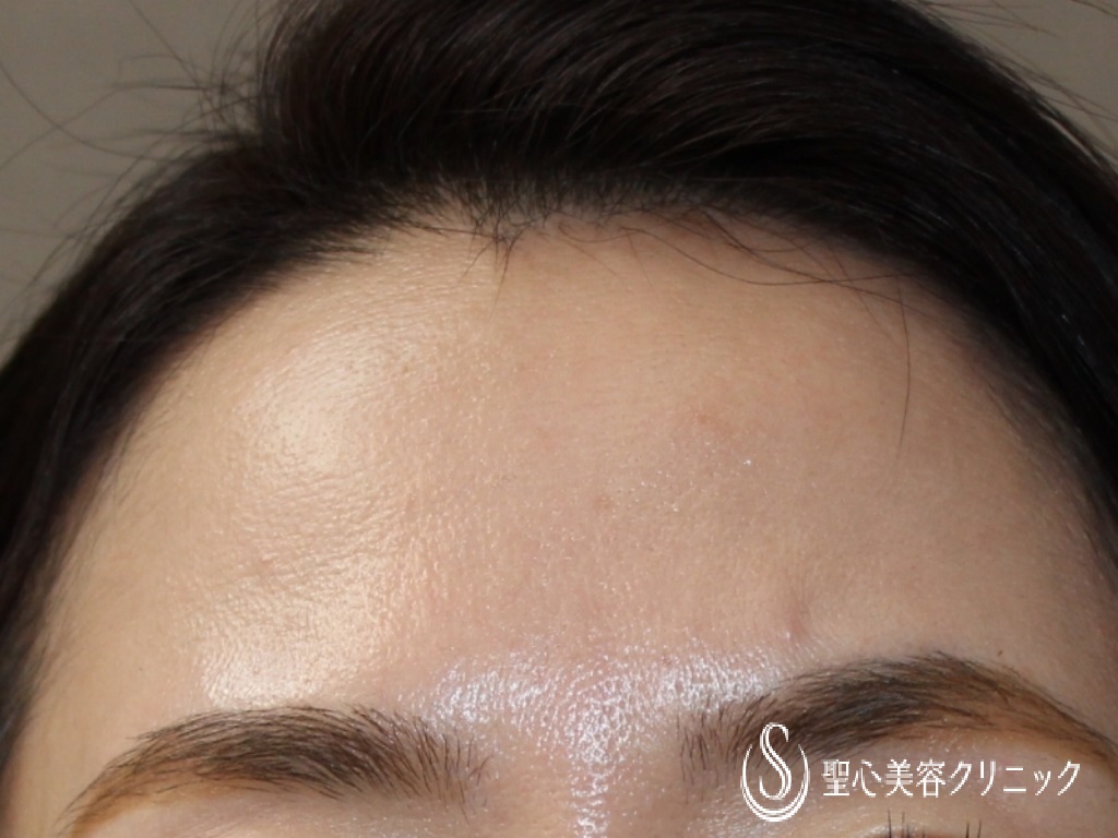 【40代女性・額をふっくらさせたい】額のプレミアムPRP皮膚再生療法（7ヶ月後） Before 