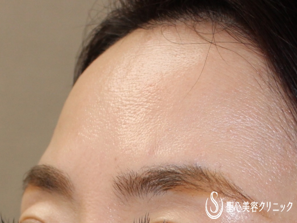 【40代女性・額をふっくらさせたい】額のプレミアムPRP皮膚再生療法（7ヶ月後） Before 