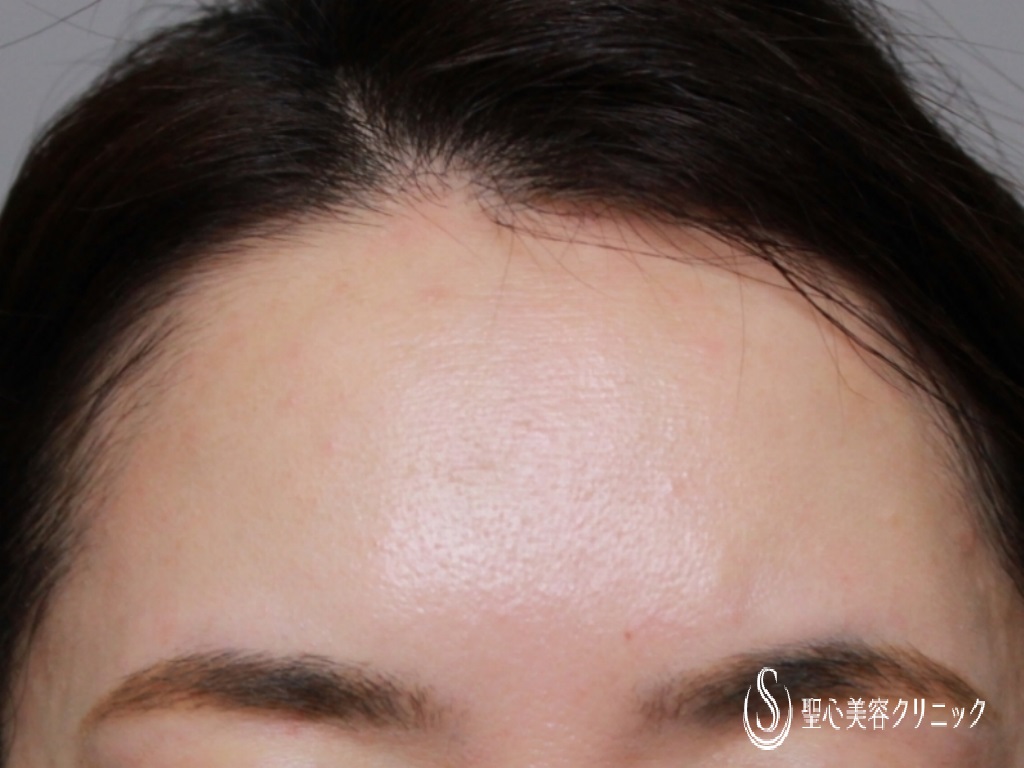 【40代女性・額をふっくらさせたい】額のプレミアムPRP皮膚再生療法（7ヶ月後） After 
