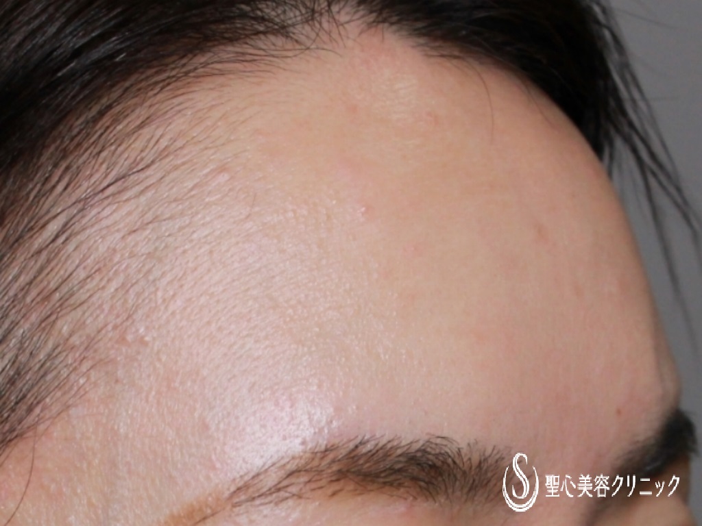 【40代女性・額をふっくらさせたい】額のプレミアムPRP皮膚再生療法（7ヶ月後） After 
