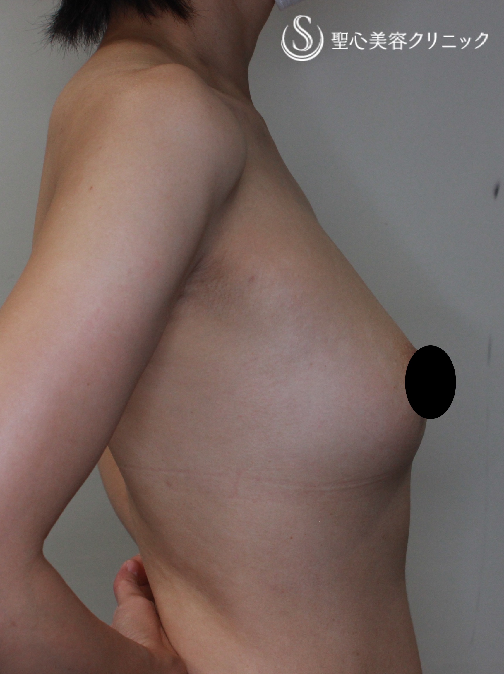 【40代女性・最新の脂肪幹細胞豊胸術】プレミアム・セリューション豊胸術（6ヶ月後） After 