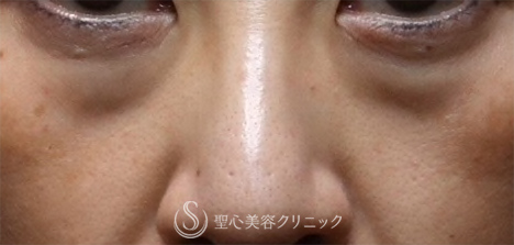 【40代女性・疲れた顔がすっきり】目の下の脂肪取り（1ヶ月後） Before 