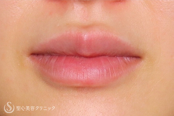 【20代女性・ヒアルロン酸で可愛い唇に】スマイルリップ（処置直後） Before 