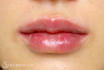 【20代女性・ヒアルロン酸で可愛い唇に】スマイルリップ（処置直後） After 