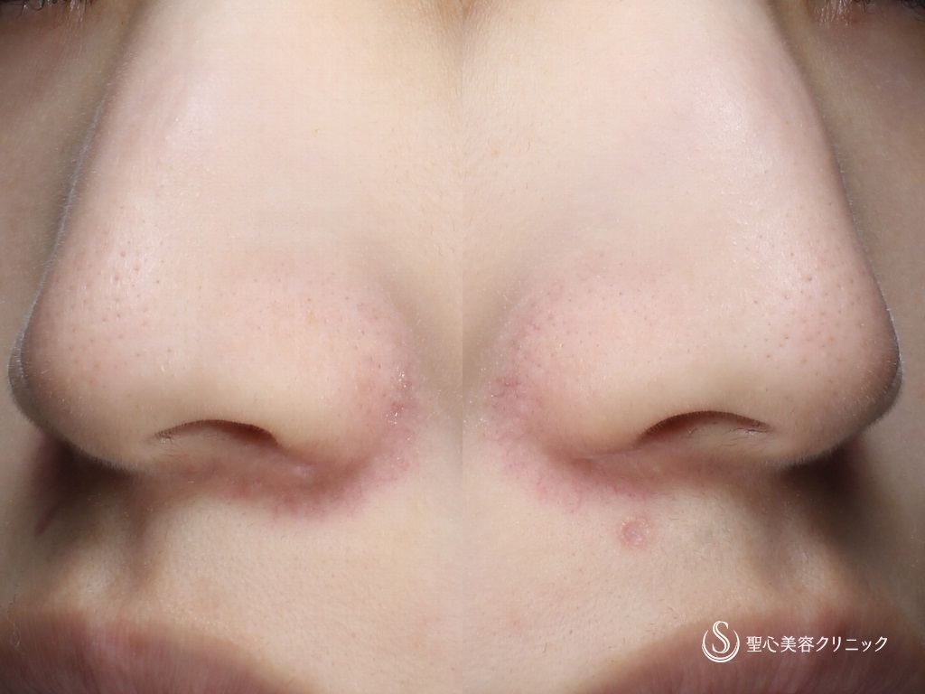 【20代女性・小鼻の赤み】585 - Quanta System Q1（2回処置後1ヶ月） After 