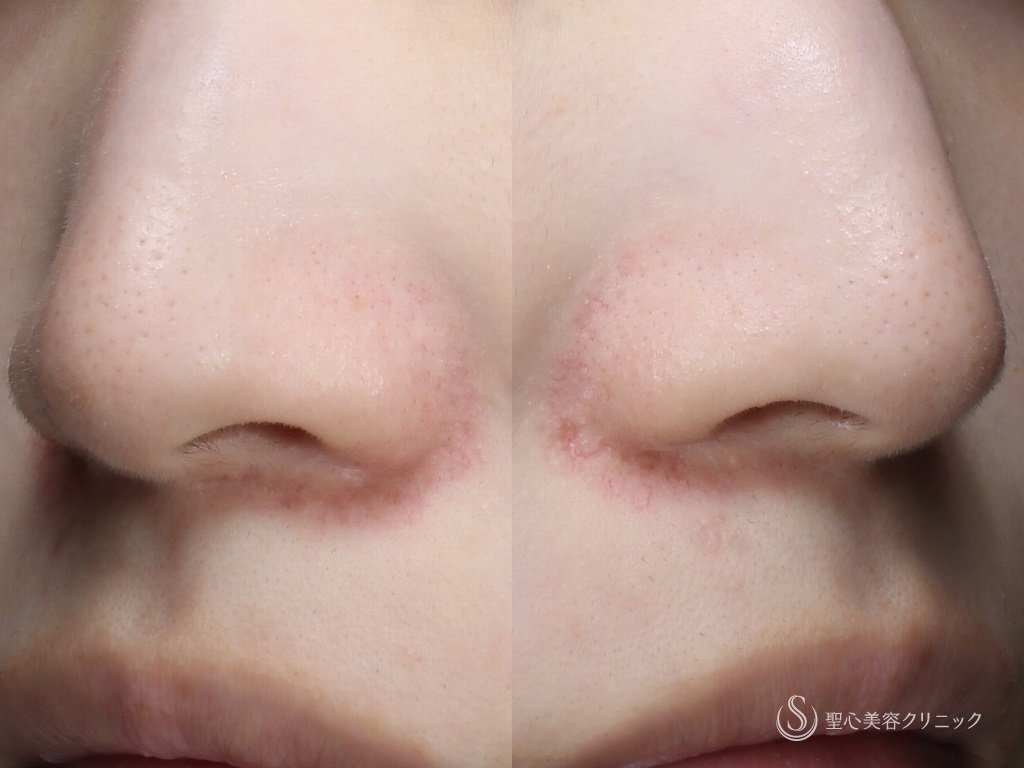 代女性 小鼻の赤み 585 Quanta System Q1 2回処置後1ヶ月 症例写真 美容整形 美容外科なら聖心美容クリニック