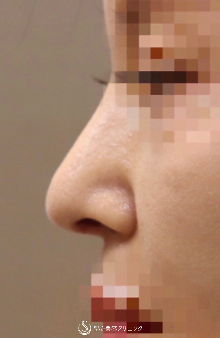 【40代女性・美人鼻に】鼻中隔延長術＋鼻尖形成術（耳介軟骨移植）（術後2ヶ月） After 
