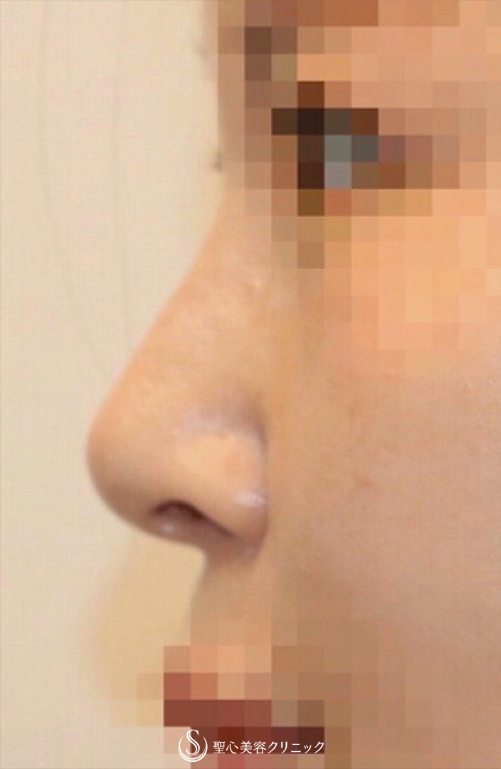 【40代女性・美人鼻に】鼻中隔延長術＋鼻尖形成術（耳介軟骨移植）（術後2ヶ月） Before 