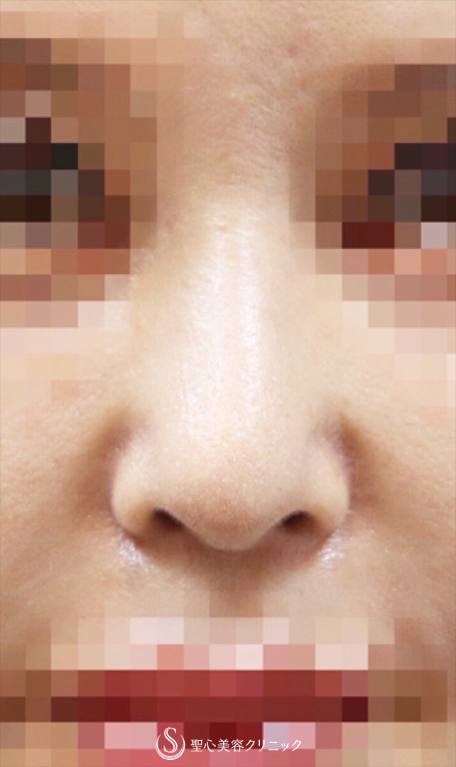 【40代女性・美人鼻に】鼻中隔延長術＋鼻尖形成術（耳介軟骨移植）（術後2ヶ月） After 