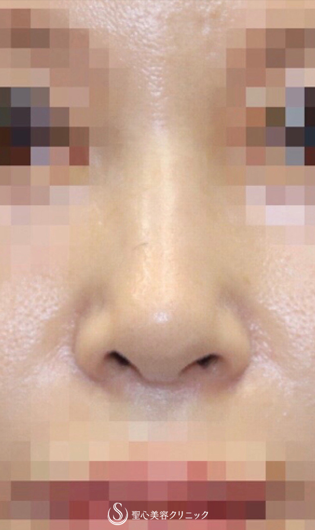 【40代女性・美人鼻に】鼻中隔延長術＋鼻尖形成術（耳介軟骨移植）（術後2ヶ月） Before 