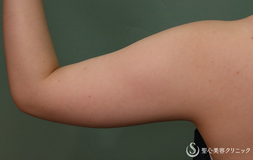 【30代女性・二の腕痩身】ベイザーリポ2.2脂肪吸引（1ヶ月後） Before 