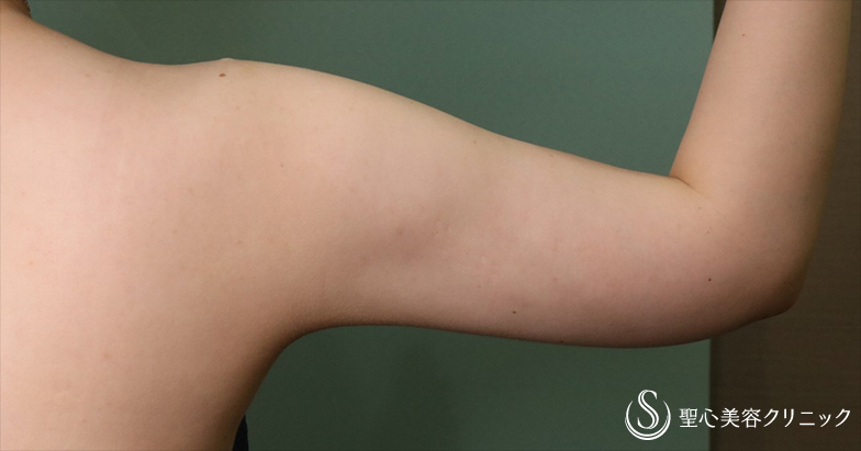【30代女性・二の腕痩身】ベイザーリポ2.2脂肪吸引（1ヶ月後） After 