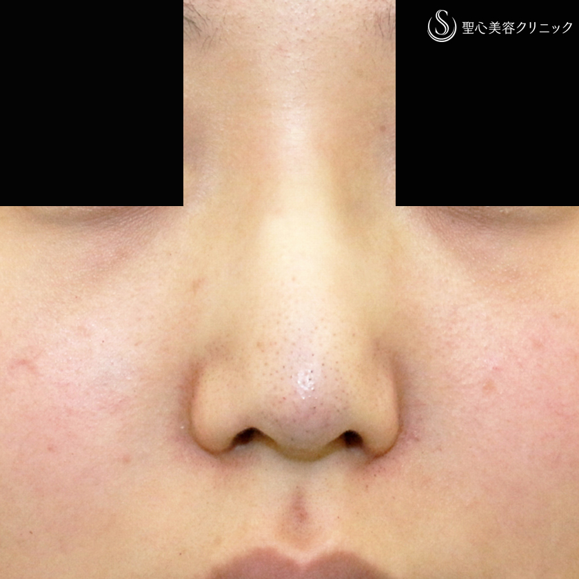 【20代女性・画期的なダンゴ鼻の治療】3D鼻尖用・PCLドーム（1年後） Before 