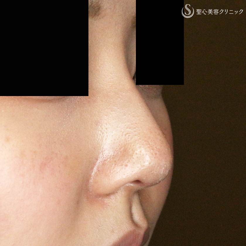 【20代女性・画期的なダンゴ鼻の治療】3D鼻尖用・PCLドーム（1年後） After 