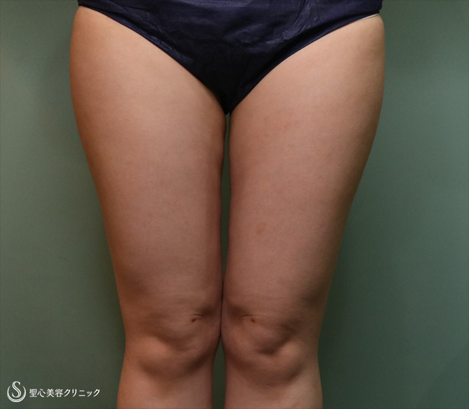 【30代女性・太もも痩身】ベイザーリポ2.2脂肪吸引（1ヶ月後） After 