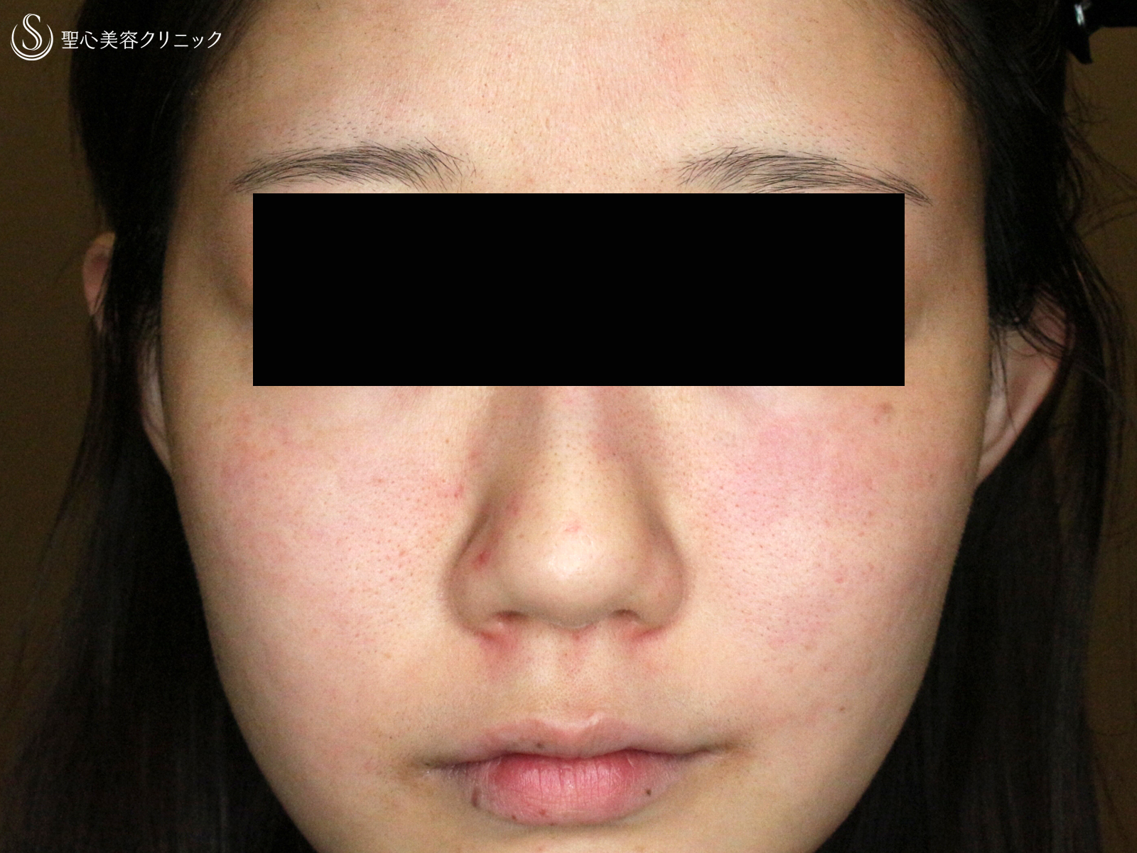 【20代女性・赤ら顔の治療】585 Quanta System Q1モニター（3回後） Before 