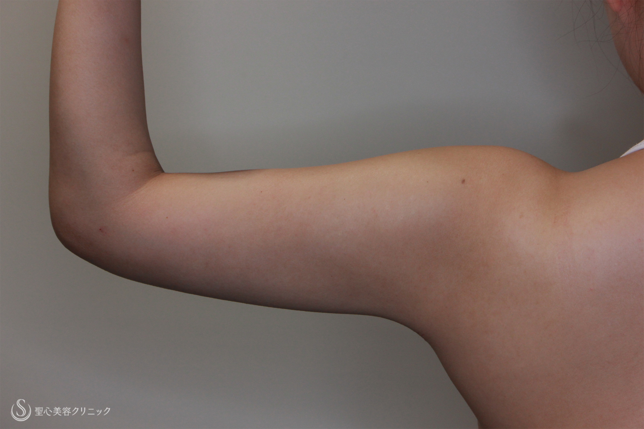 【30代女性・二の腕の脂肪吸引】ベイザーリポ2.2（1ヶ月後） After 