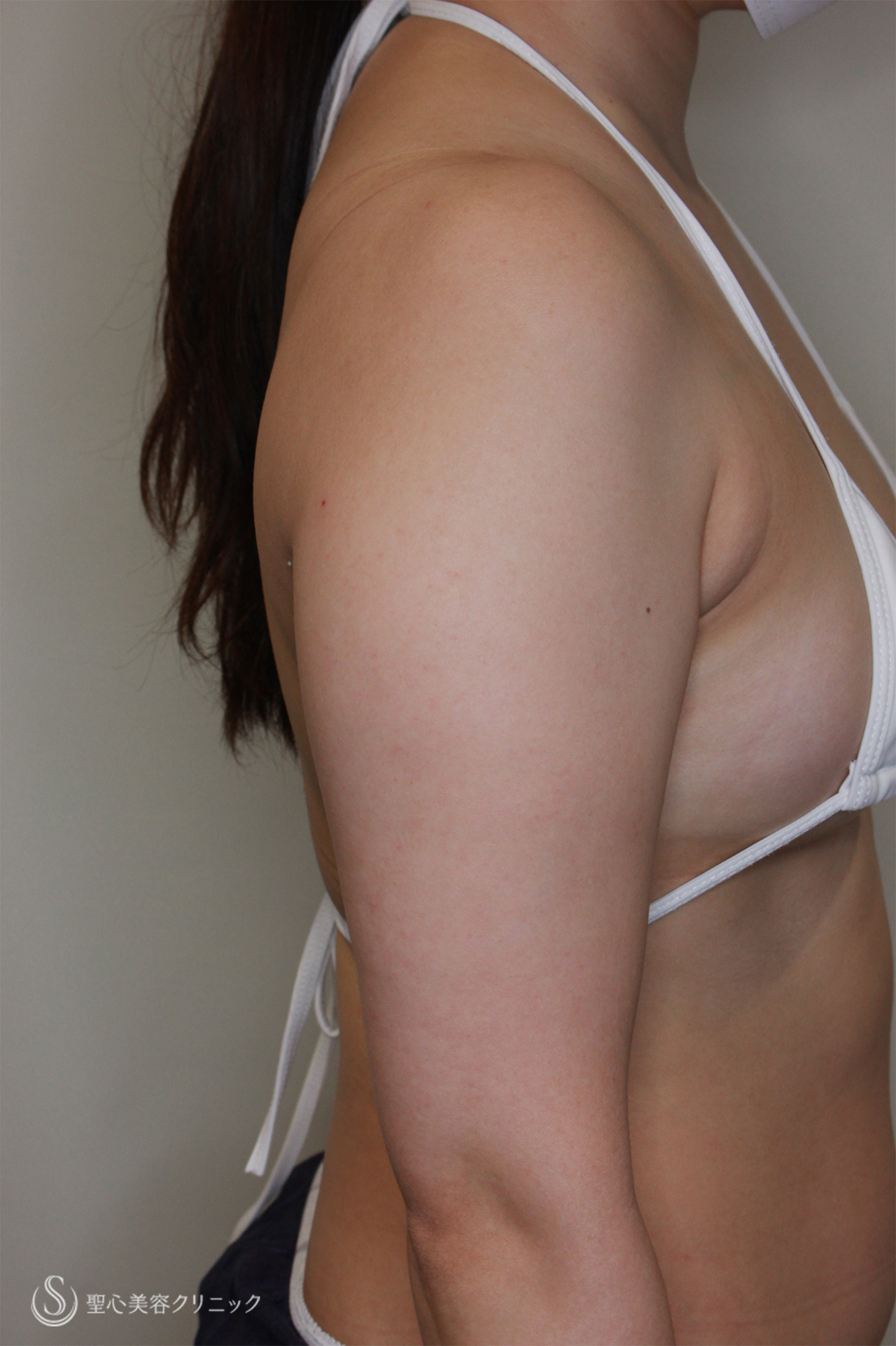 【30代女性・二の腕の脂肪吸引】ベイザーリポ2.2（1ヶ月後） Before 
