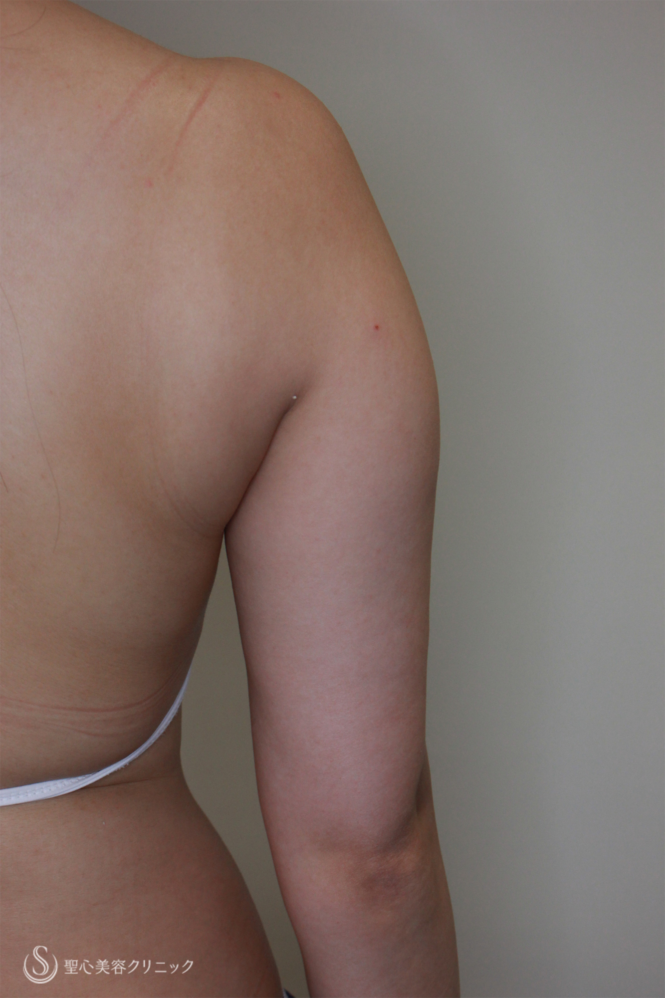 【30代女性・二の腕の脂肪吸引】ベイザーリポ2.2（1ヶ月後） Before 