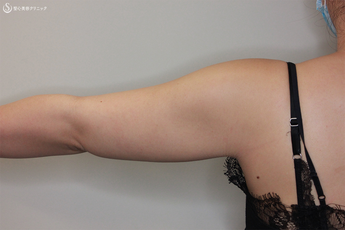 【30代女性・二の腕の脂肪吸引】ベイザーリポ2.2（1ヶ月後） 症例写真 美容整形、美容外科なら聖心美容クリニック