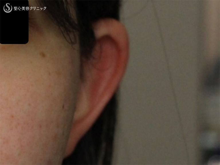 【20代女性・立ち耳を改善】立ち耳修正（切開法）（6ヶ月後） Before 