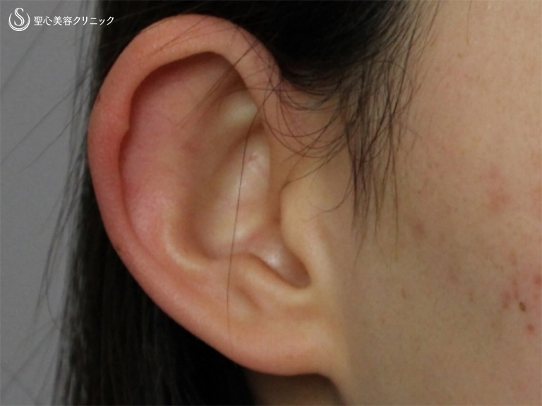 【20代女性・立ち耳を改善】立ち耳修正（切開法）（6ヶ月後） Before 