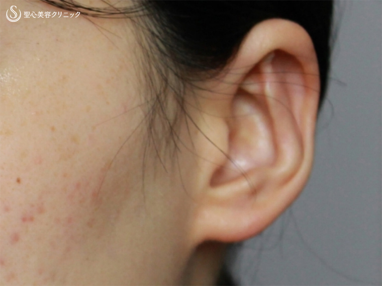 【20代女性・立ち耳を改善】立ち耳修正（切開法）（6ヶ月後） After 