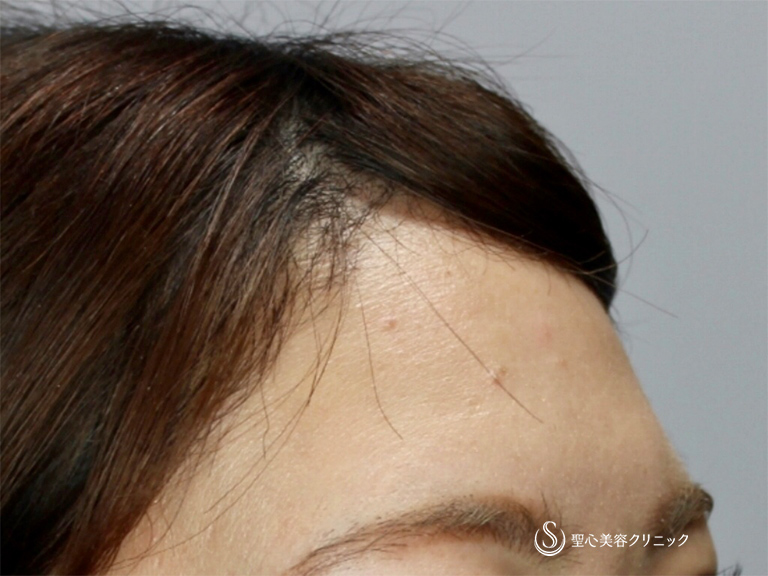 【20代女性・額の凹みを改善してふっくらさせたい】額のプレミアムPRP（1か月後） Before 