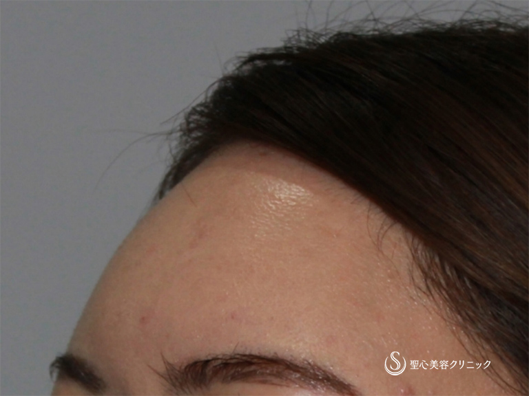 【20代女性・額の凹みを改善してふっくらさせたい】額のプレミアムPRP（1か月後） After 